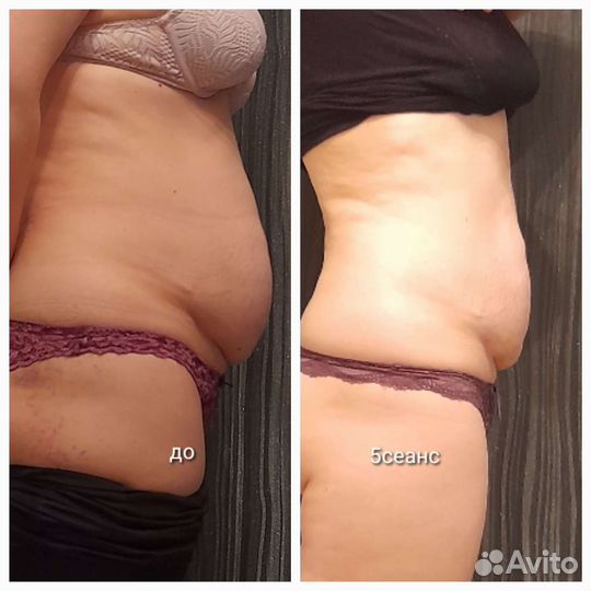 Кавитация,rfвакуум,rfлифтинг, вибромассаж