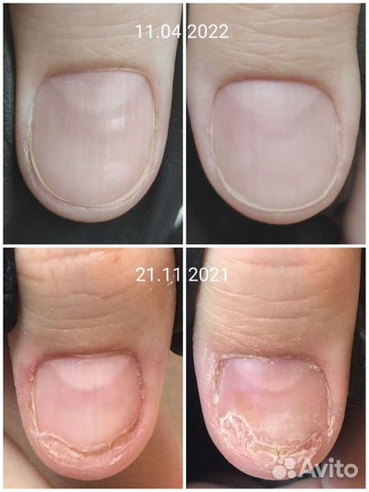 Педикюр/Подология/Работа со сложной стопой