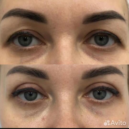 Блефаропластика