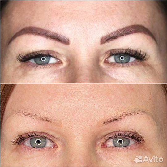 Удаление тату и татуажа лазером и ремувером