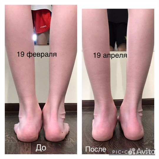 Коррекция вальгуса и осанки детям и взрослым