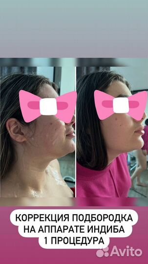 Индиба похудение, коррекция