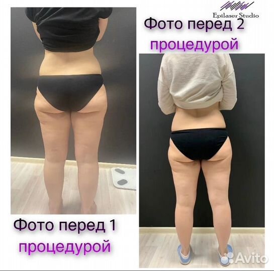 Криолиполиз -минус размер за одну процедуру