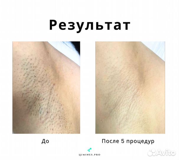 Диодный лазер для эпиляции люминес Макс Ван 1200в