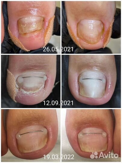 Педикюр/Подология/Работа со сложной стопой