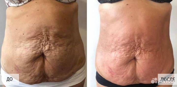 Массаж коррекция фигуры