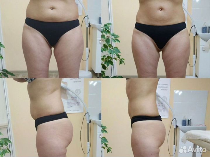 Снижения веса /LPG и Прессотерапия сеанс