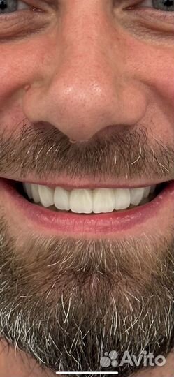 Протезирование зубов, керамические виниры