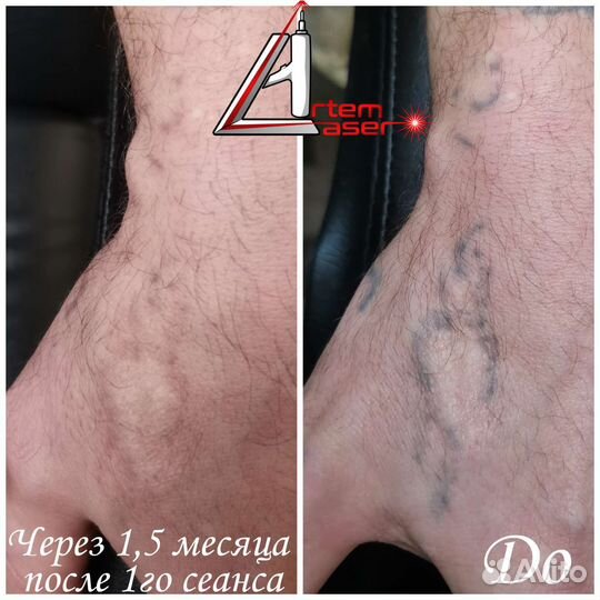 Лазерное удаление тату и татуажа