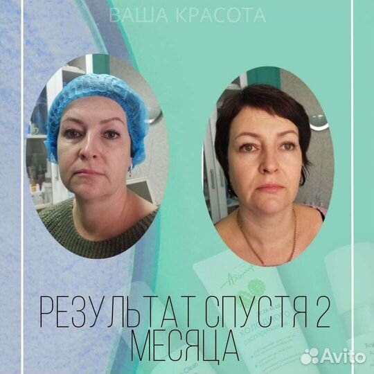 Смас лифтинг аппаратный