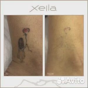 Удаление татуировки лазером PicoSure