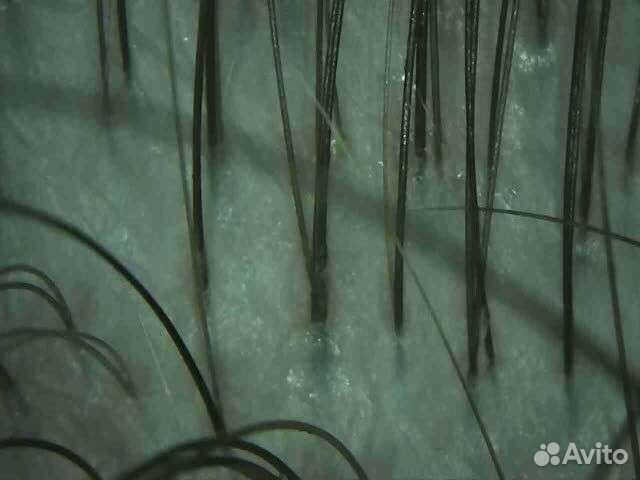 Пилинг кожи головы