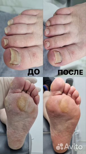 Приглашаем моделей на подологический педикюр