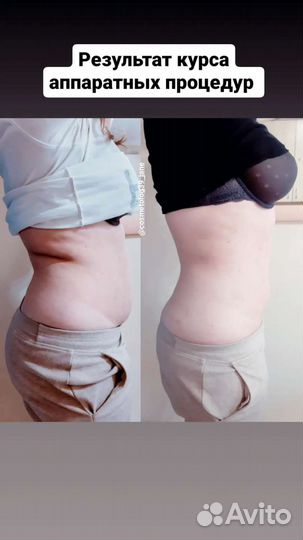 Кавитация,рф лифтинг,вакуум массаж,миостимуляция