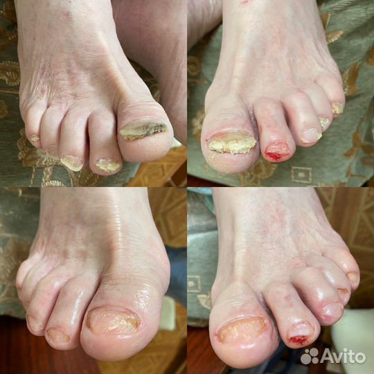 Педикюр подолог выезд на дом