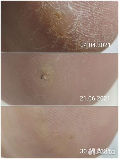 Педикюр/Подология/Работа со сложной стопой