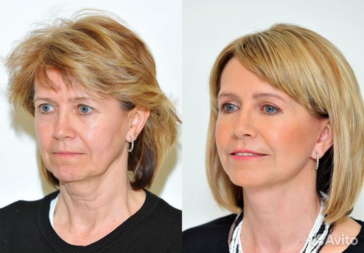 Модели на Смас лифтинг лица без оплаты