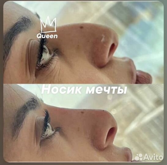 Косметолог. Губы. Ботокс