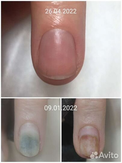 Педикюр/Подология/Работа со сложной стопой