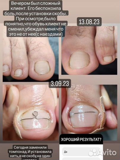 Лечебный педикюр подолог