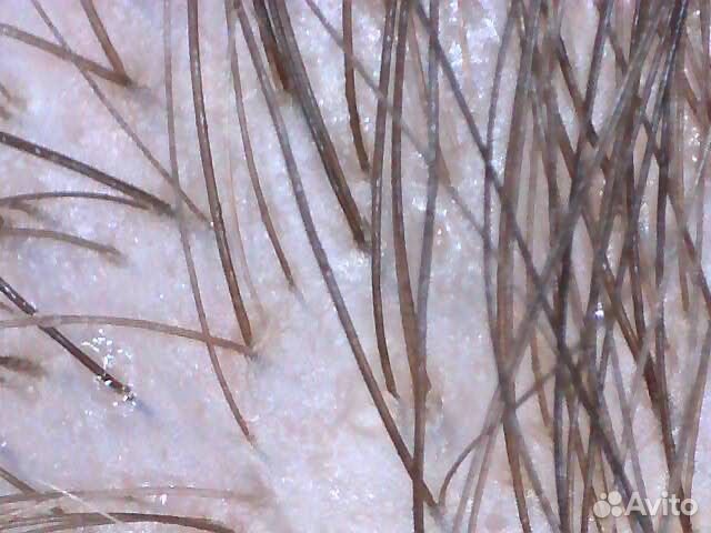 Консультация трихолога-эстетиста