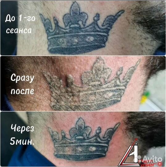 Лазерное удаление тату и татуажа