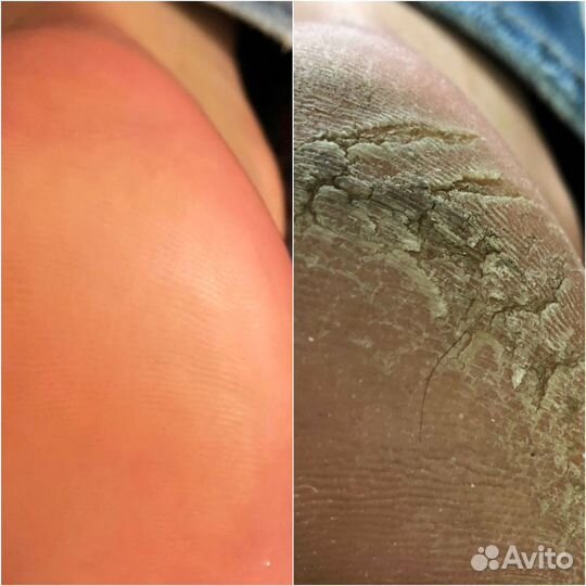 Педикюр, коррекционная система, маникюр, укреплени