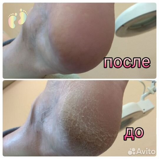 Коррекция вросшего ногтя