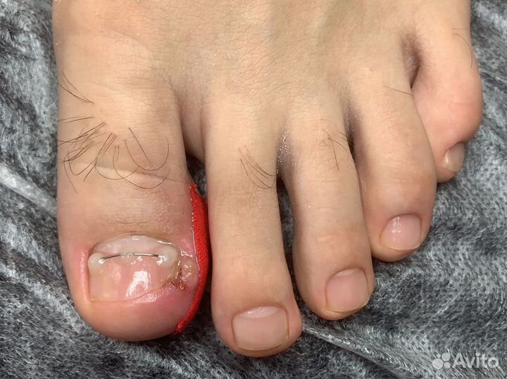 Педикюр медицинский.Титановые нити.Подолог