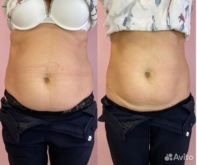 Плоский живот - размер за 1 процедуру в Красноярск