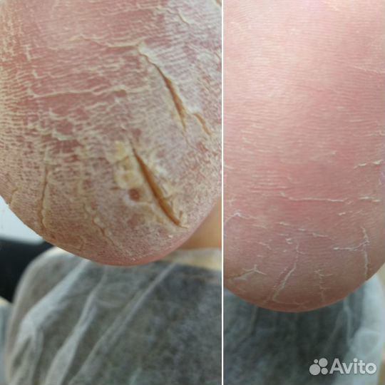 Педикюр аппаратный (Мужской и Женский) Подолог