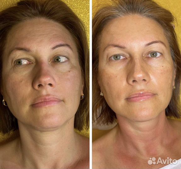 Омоложение холодной плазмой