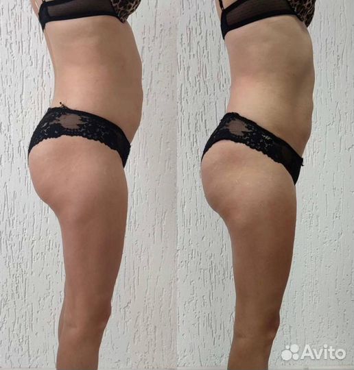 Аппаратный массаж (курс фигура песочные часы)