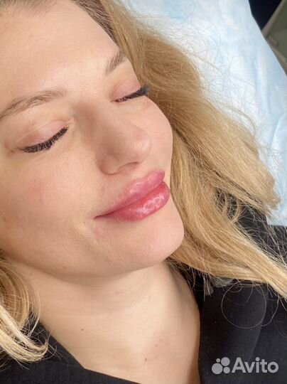 Увеличение губ, косметолог