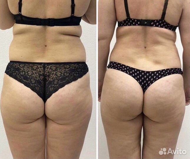 Массаж коррекция фигуры(жиротоп)