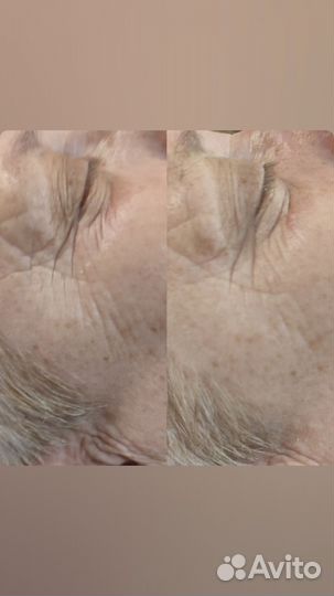 Пилинг лица