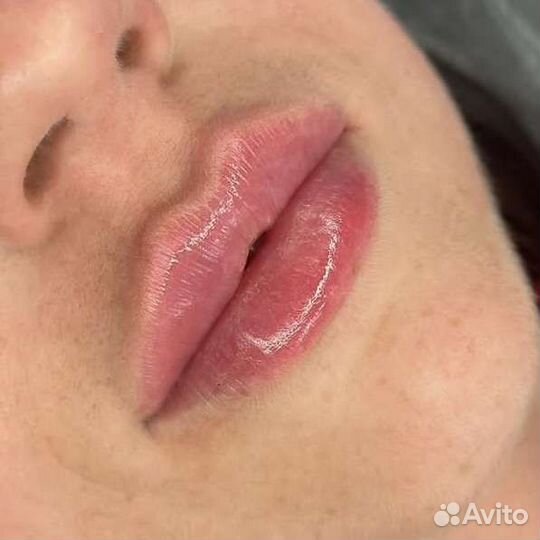 Увеличение губ