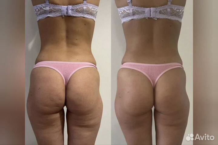 Снижения веса /LPG и Прессотерапия сеанс