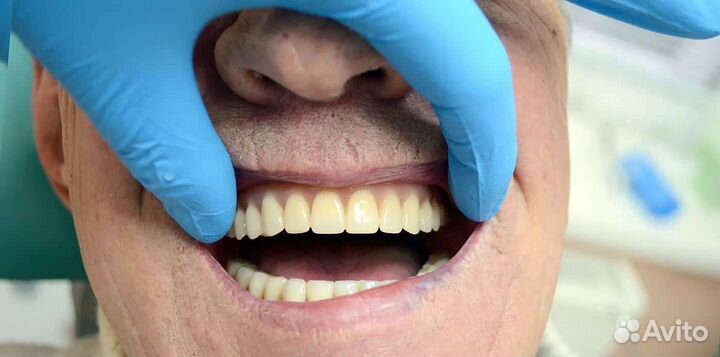 Зубные протезы