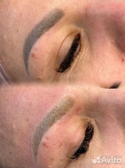 Удаление татуажа