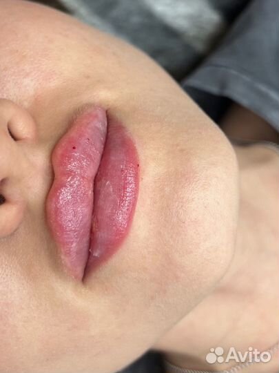 Увеличение губ