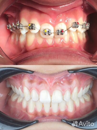 Брекеты