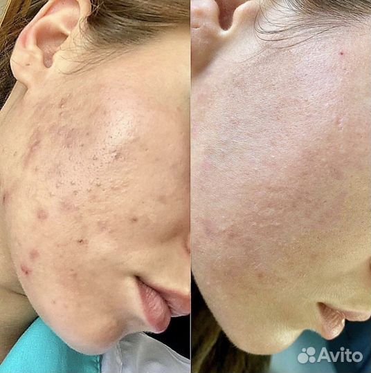 Чистка лица