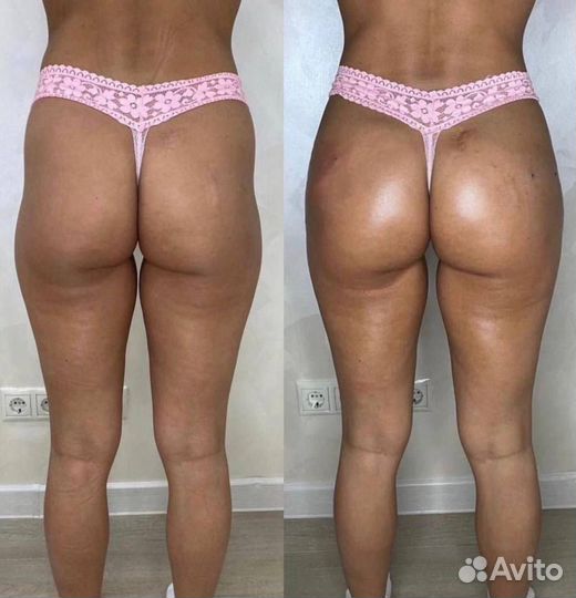 Увеличение ягодиц филлерами