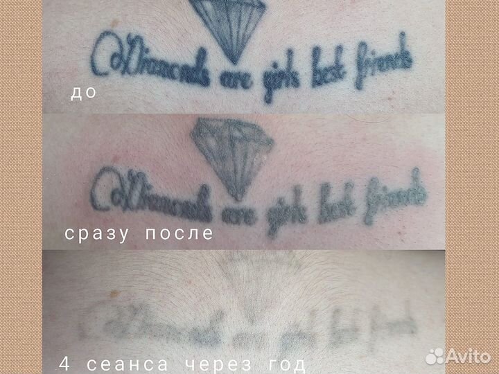 Удаление тату лазером