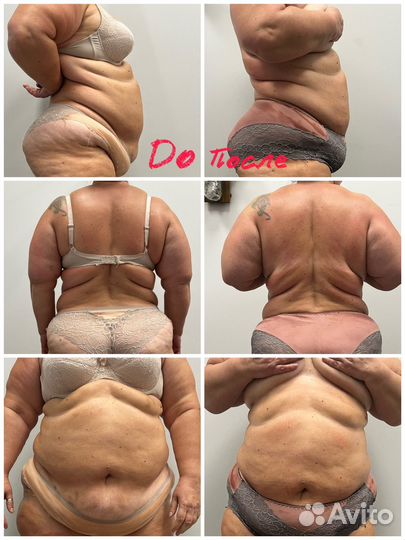 Аппаратный массаж