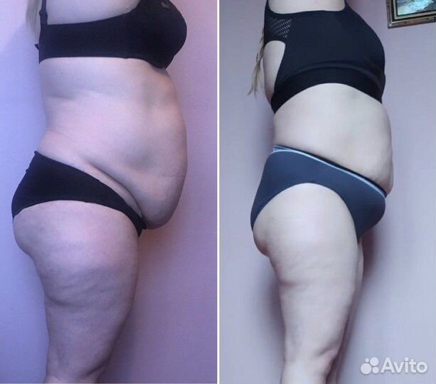 Массаж LPG и Шугаринг