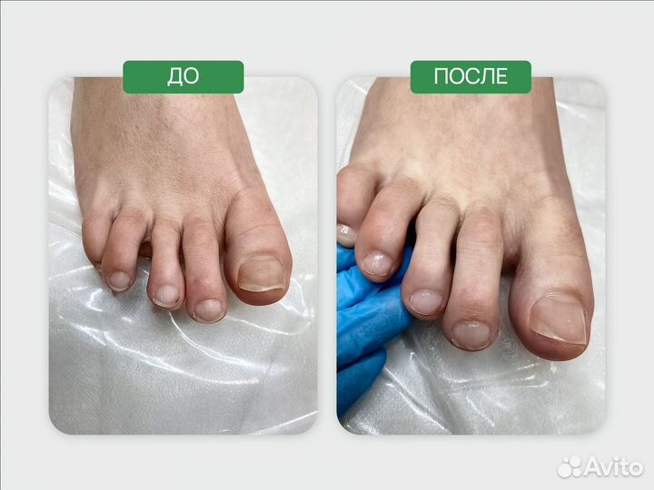 Подолог, вросшие ногти, медицинский педикюр