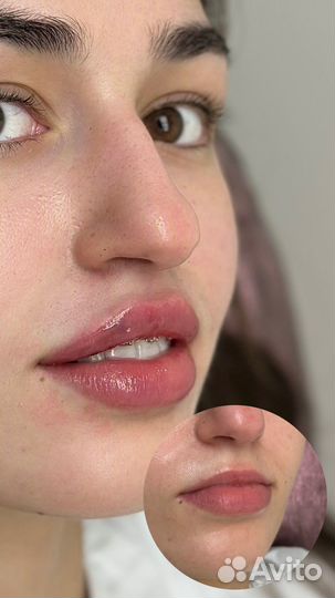 Врач-косметолог. Губы, ботокс