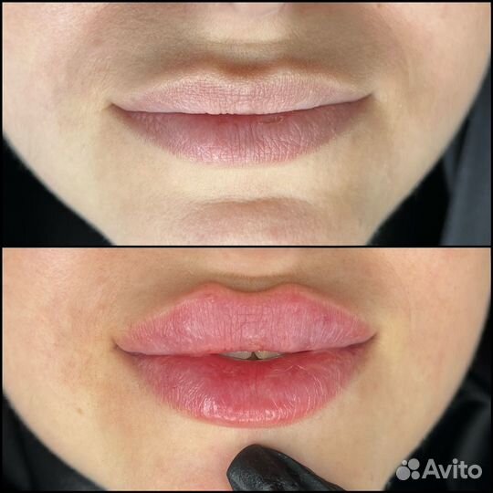 Увеличение губ